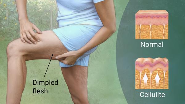 How to Get Rid of Cellulite
#herbnwisdom #heatherearles #naturalliving #bonebroth #broth #homesteading #naturalremedies #healthydrinks #health #beefbones