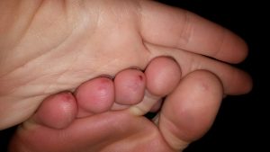 What does Chilblains look like?