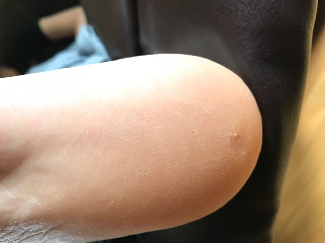 All about Corns and Calluses?
#HeatherEarles #herbnwisdom #naturalliving #footcare #naturalremedies