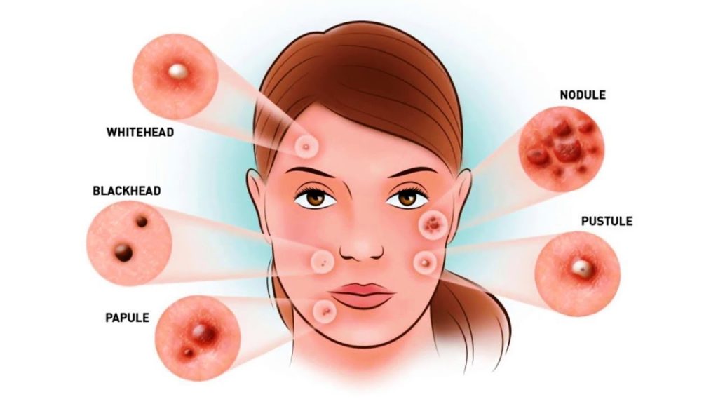 How witch-hazel can help with acne.
#HeatherEarles #herbnwisdom #naturalliving #acne #skincare