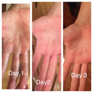 Hand Foot and Mouth Disease