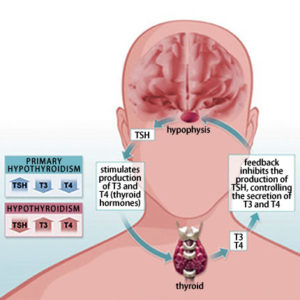 hypothyroidism