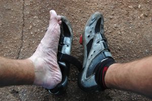 what does trench foot look like?