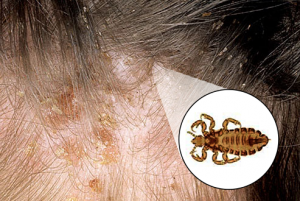 how to prevent lice infection